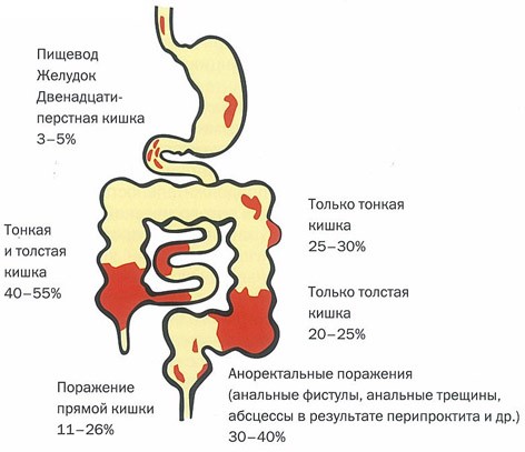 Болезнь Крона лечение в Киеве и Одессе