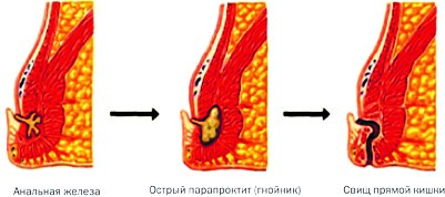 Парапроктит, лечение в Киеве и Одессе