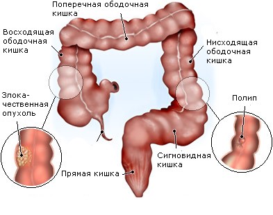 Рак ободочной кишки - Одесса