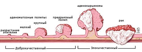 Рак ободочной кишки в Киеве и Одессе