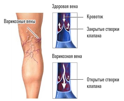 Варикозная болезнь