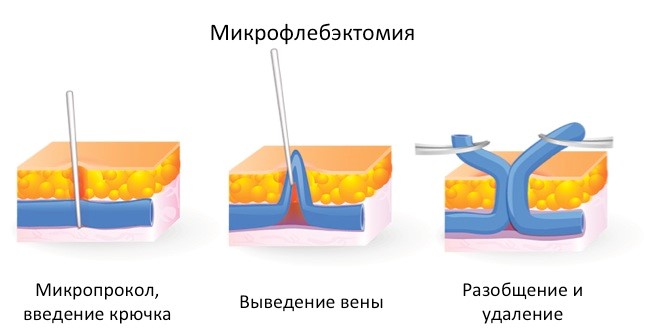Варикозная болезнь