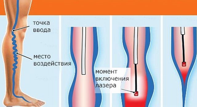 Варикозная болезнь