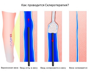 Варикозная болезнь