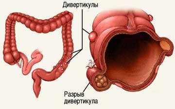 Дивертикулёз толстой кишки