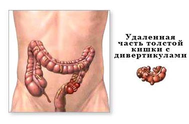Дивертикулёз толстой кишки