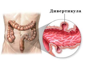 Ректовагинальный свищ