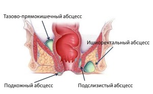 Ректовагинальный свищ