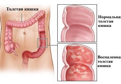 Язвенный колит