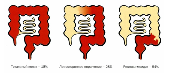 Язвенный колит
