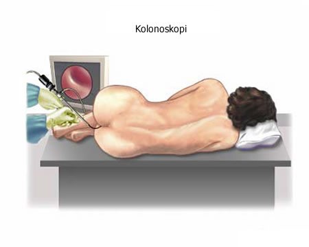 Язвенный колит