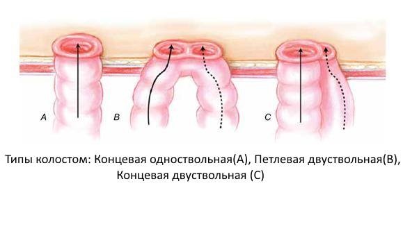 Кишечные стомы