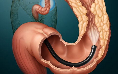 C0014965-Colon_Cancer-zahod
