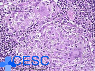 CD_Granuloma21