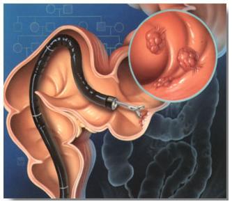 colonoscopy-and-biopsy